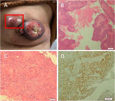 Case report: Apatinib combined with neoadjuvant therapy for primary squamous cell carcinoma of the breast: a case report